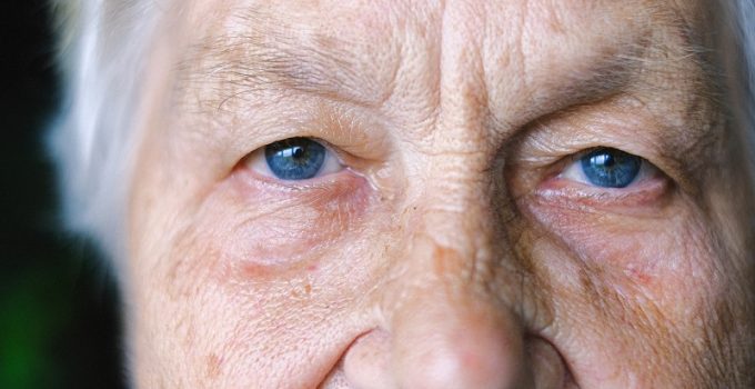 What is Ptosis?